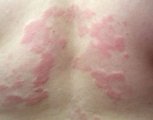 Vücutta Kaşıntı ve Morarma Belirtileri ve Tedavisi Vücutta Kaşıntı ve Morarma Belirtileri ve Tedavisi