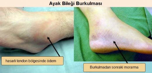 Bilek Burkulmas Morarma